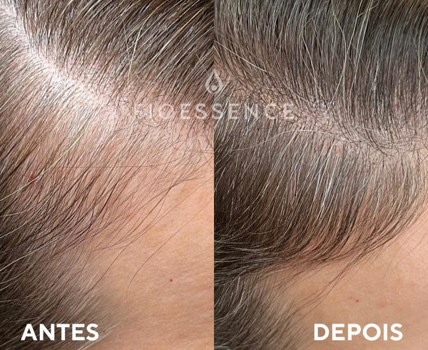 Reconquiste Sua Força: O Protocolo Natural que Está Transformando a Vida de Mulheres com Queda Capilar